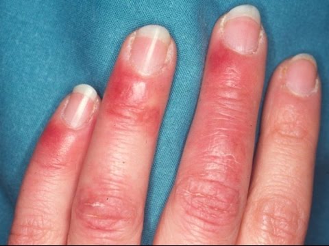 Llega el frío: Cómo curar los sabañones de las manos y de los pies · Cuidados las Heridas